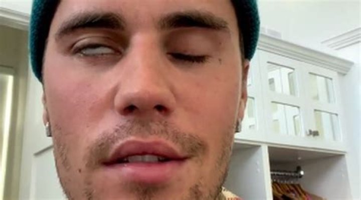 Everything Justin Bieber has said about Ramsay Hunt syndrome which left his face half paralyzed