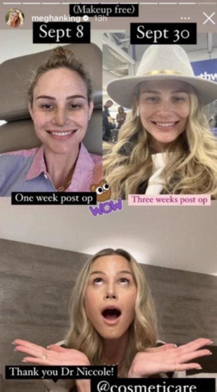 Meghan King Shares Recovery Photos After Plastic Surgery